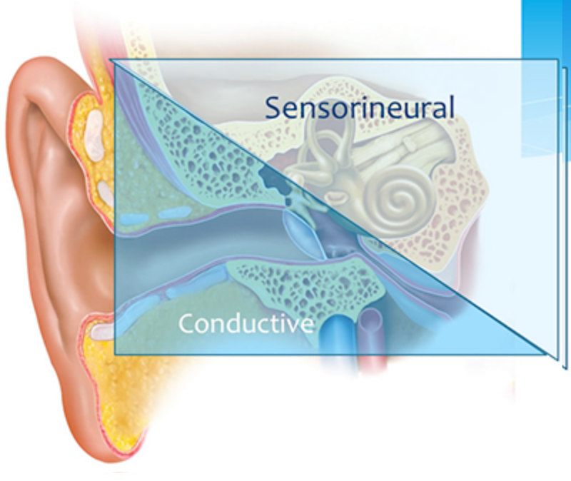 ear diagram types of hearing loss ear diagram types of hearing loss